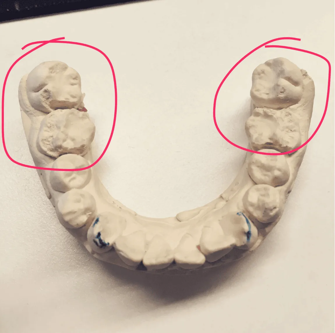牙齿磨损