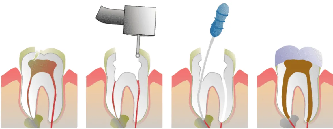 根管治疗流程图