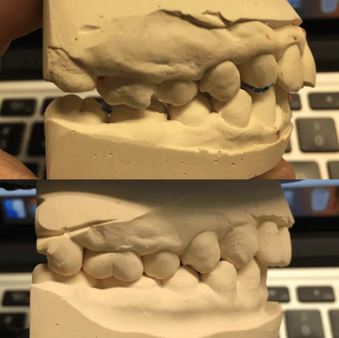 修复前和修复后的侧面对比